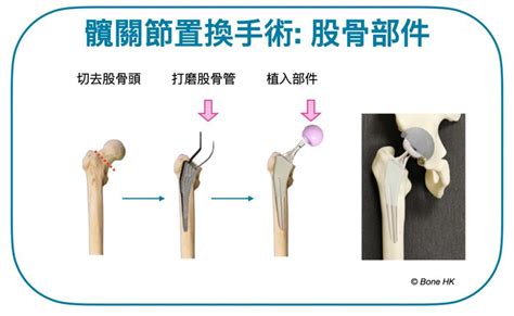 骨枯手術費用|髖關節手術價錢比較！髖關節置換手術需知馬上了解！